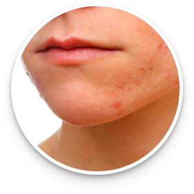 Dermatix - acne scar