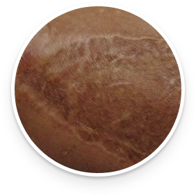 Dermatix - burn scar